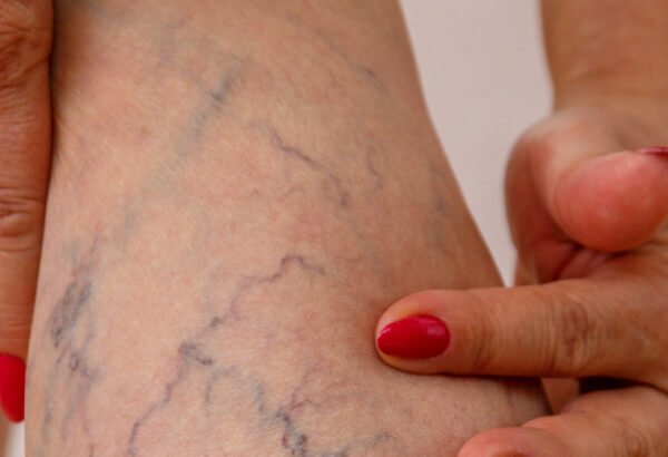 How To Manage Spider Veins With Professional Help