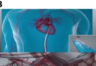 Interventional Radiology Techniques for Treating Aneurysms