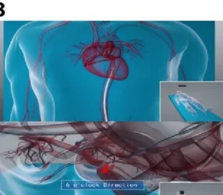 Interventional Radiology Techniques for Treating Aneurysms