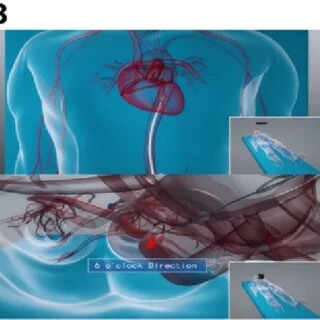 Interventional Radiology Techniques for Treating Aneurysms