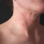 The Role of Childhood Eczema Resources in Managing Eczema