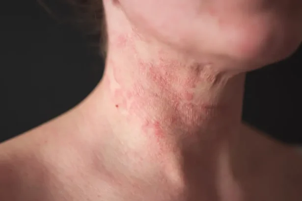 The Role of Childhood Eczema Resources in Managing Eczema