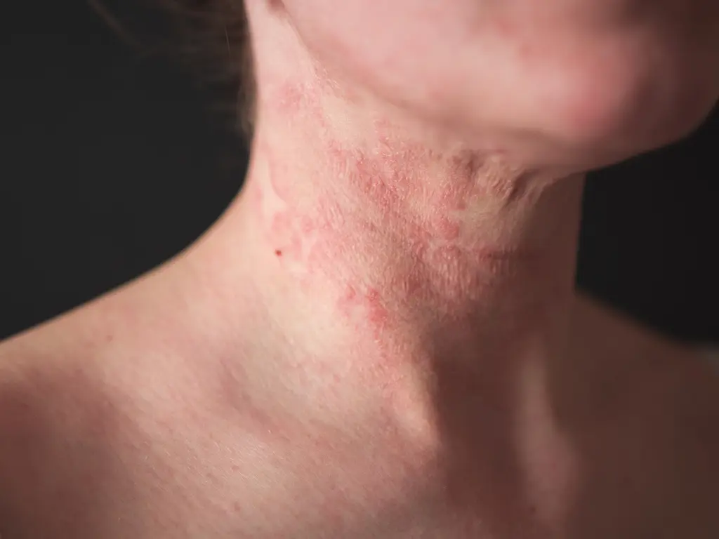 The Role of Childhood Eczema Resources in Managing Eczema